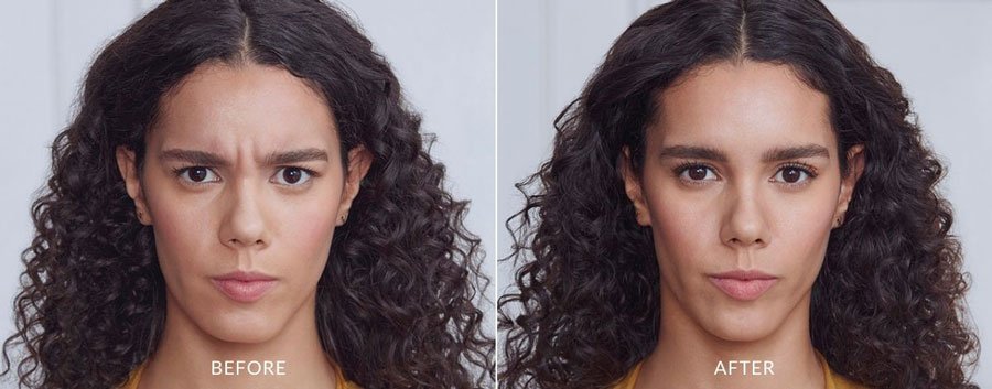 Botox Before and After — The Firm Medspa