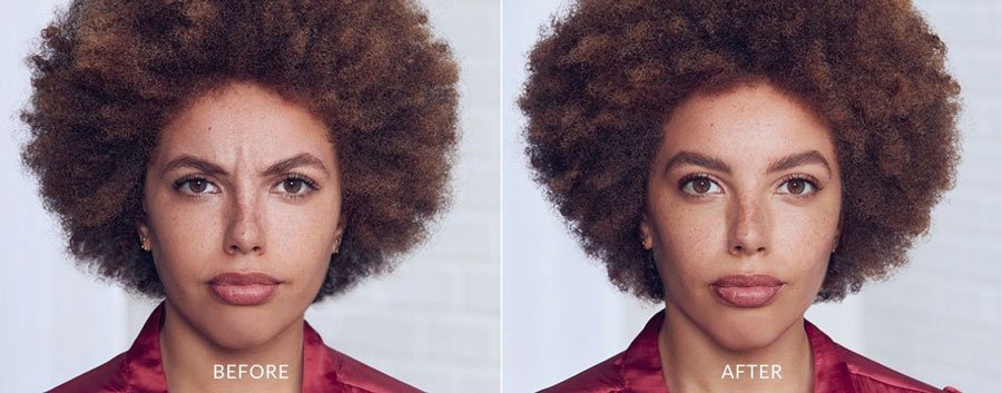 Botox Before and After — The Firm Medspa