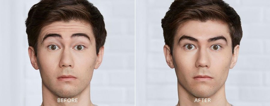 Botox Before and After — The Firm Medspa