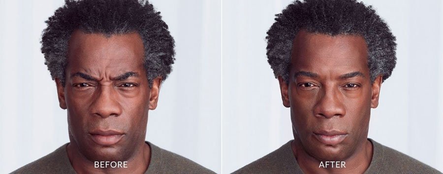 Botox Before and After — The Firm Medspa