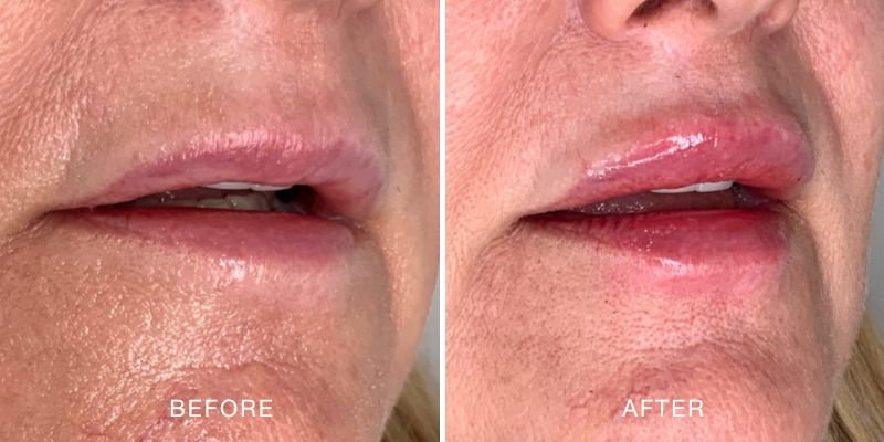 Dermal Filler Before and After — Lip volume