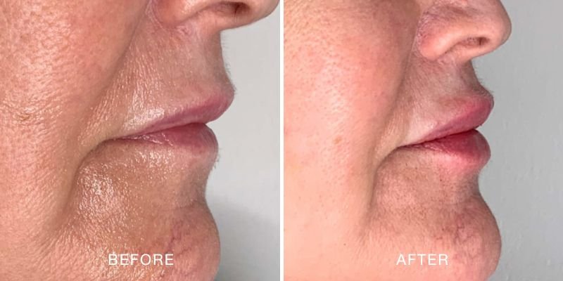 Dermal Filler Before and After — Lip volume