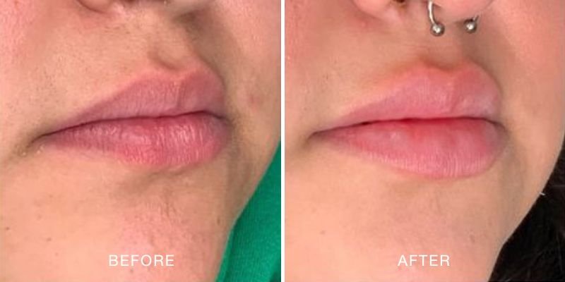 Dermal Filler Before and After — Lip volume