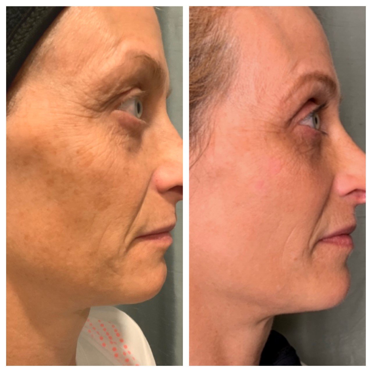 Dye VL before and after