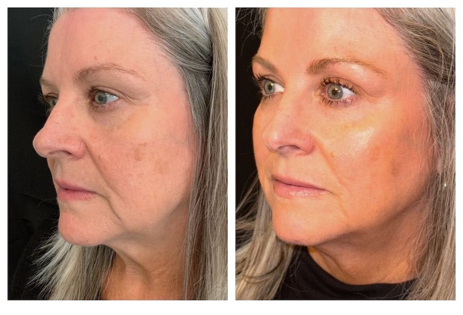 Emface Before and After