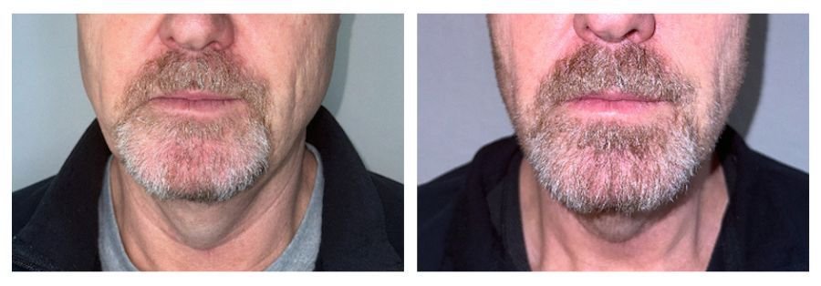 Emface Before and After