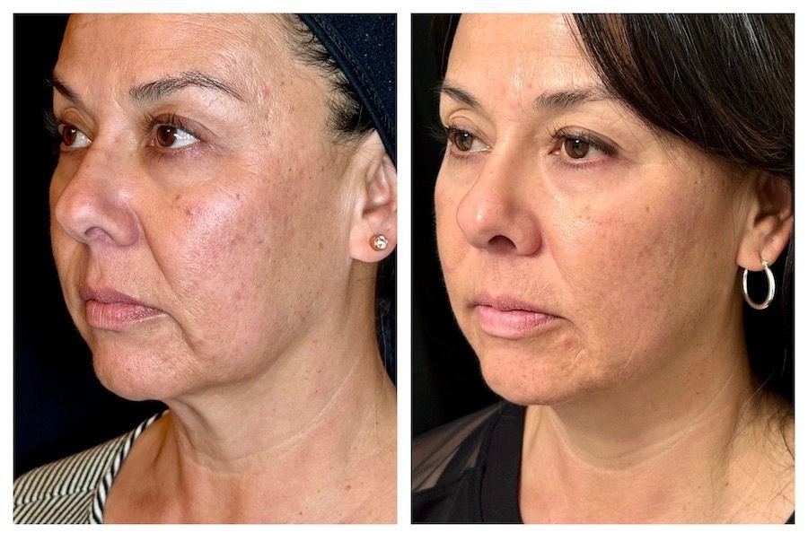 Emface Before and After