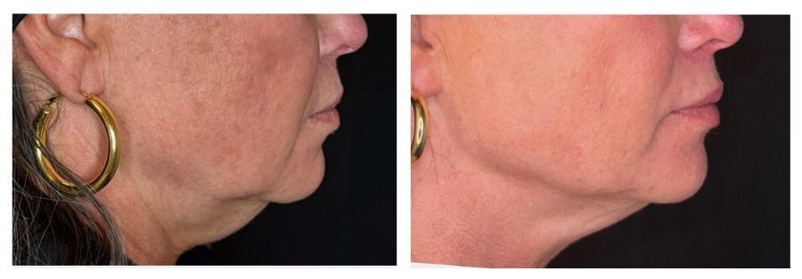 Emface Before and After