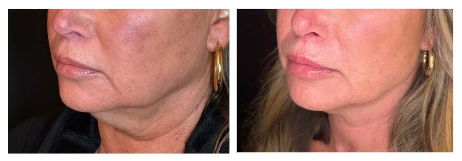 Emface Before and After