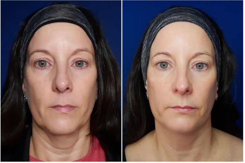 Environ Ionzyme DF Before and After