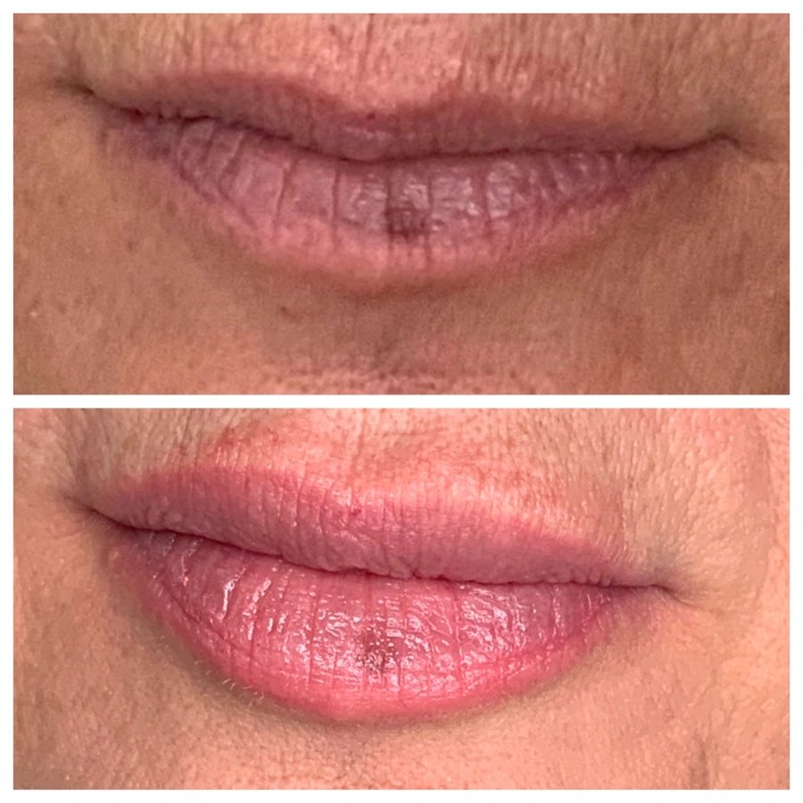 Lip Filler Before and After — The Firm Medspa