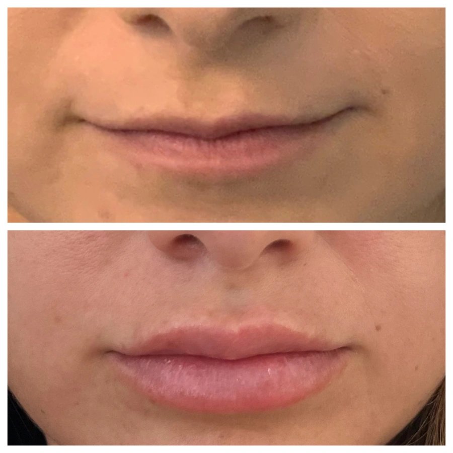Lip Filler Before and After — The Firm Medspa