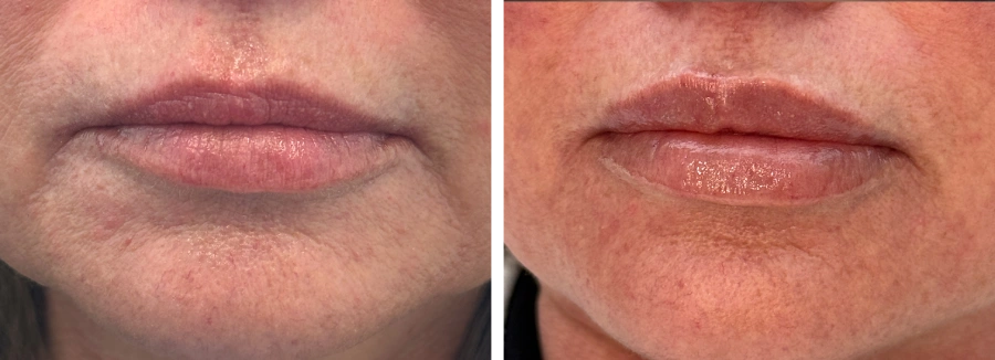 Lip Filler Before and After — The Firm Medspa