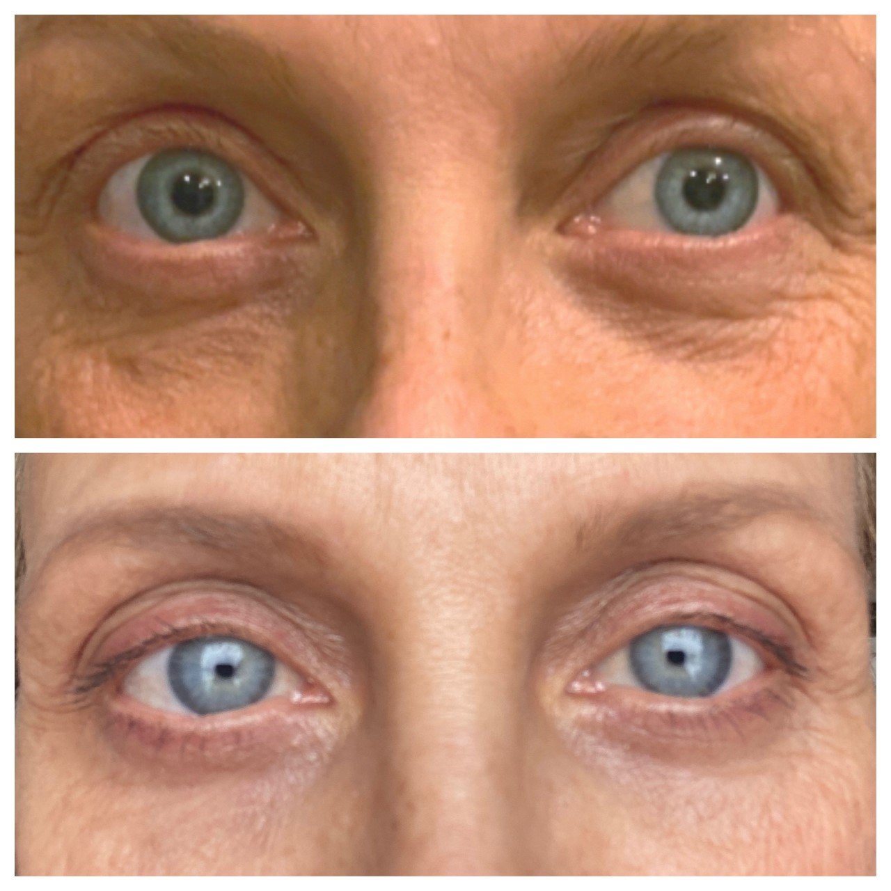 Opus Skin Resurfacing Before & After 1