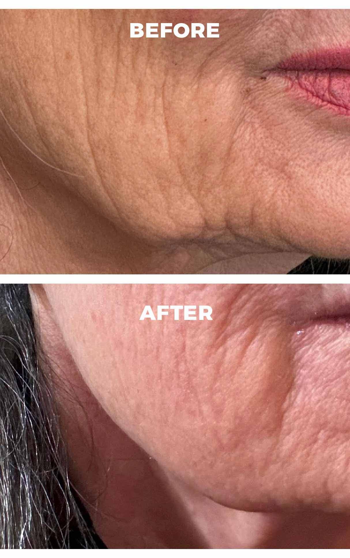 Opus Plasma Laser Before & After 1