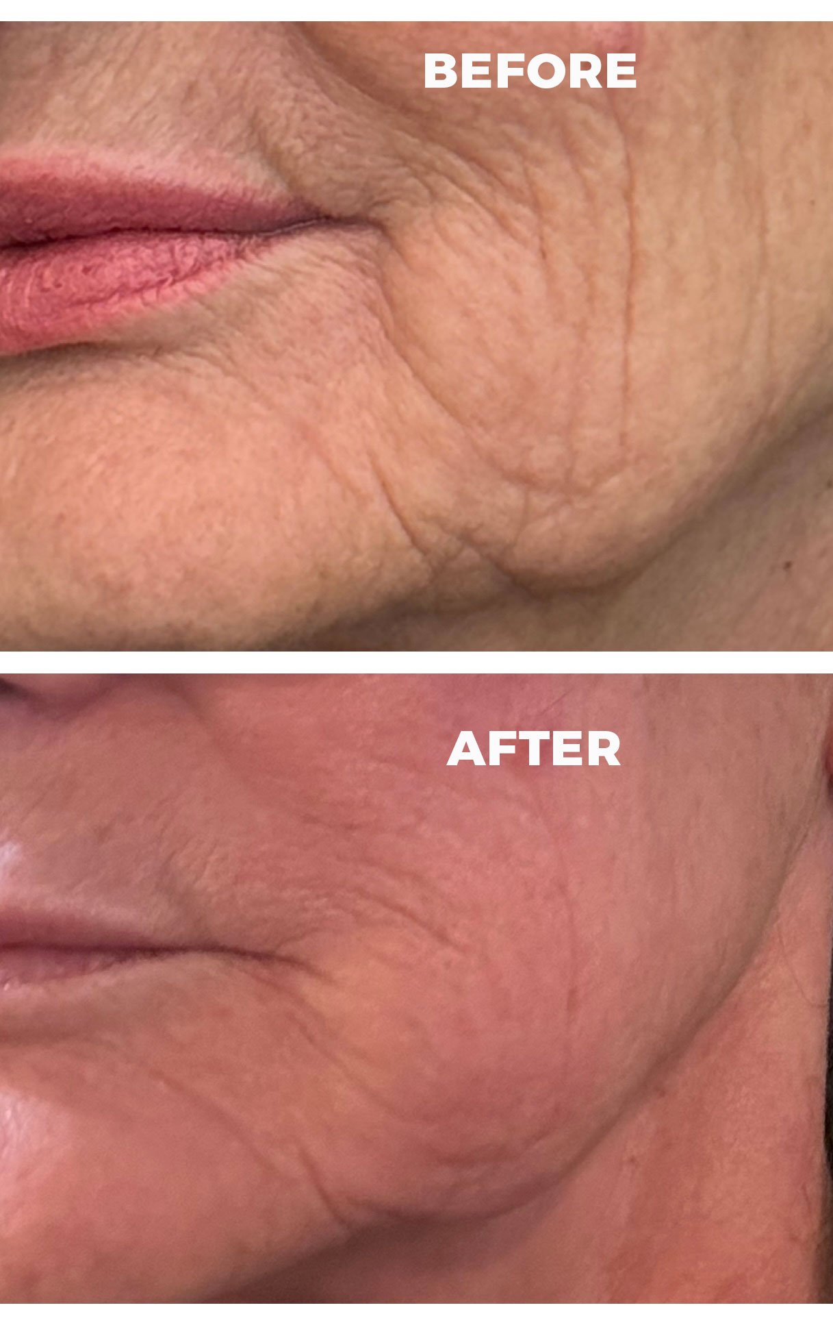 Opus Plasma Laser Before & After 2
