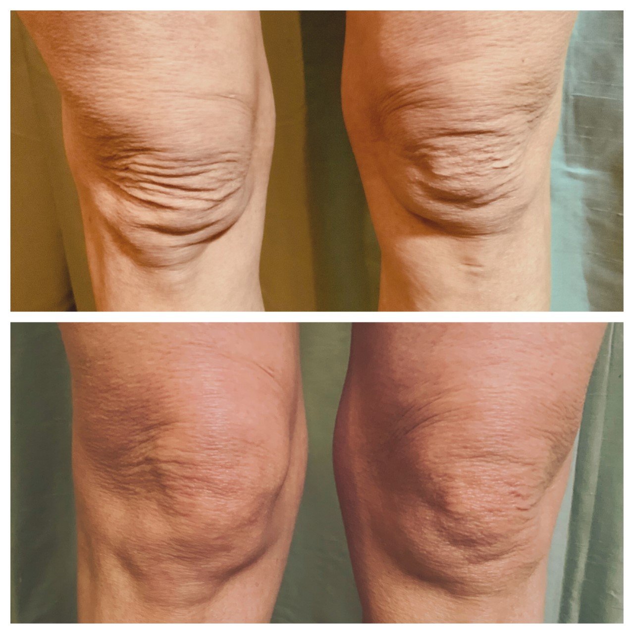 Opus Skin Resurfacing Knees Before & After