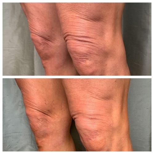 Skin Tightening Before & After 1