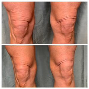 Skin Tightening Before & After 2