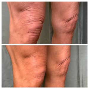 Skin Tightening Before & After 3