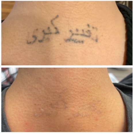 Laser Tattoo Removal Before & After